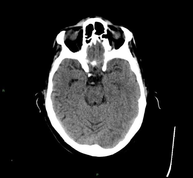 File:Cerebral amyloid angiopathy-associated lobar intracerebral hemorrhage (Radiopaedia 58529-65681 Axial non-contrast 34).jpg