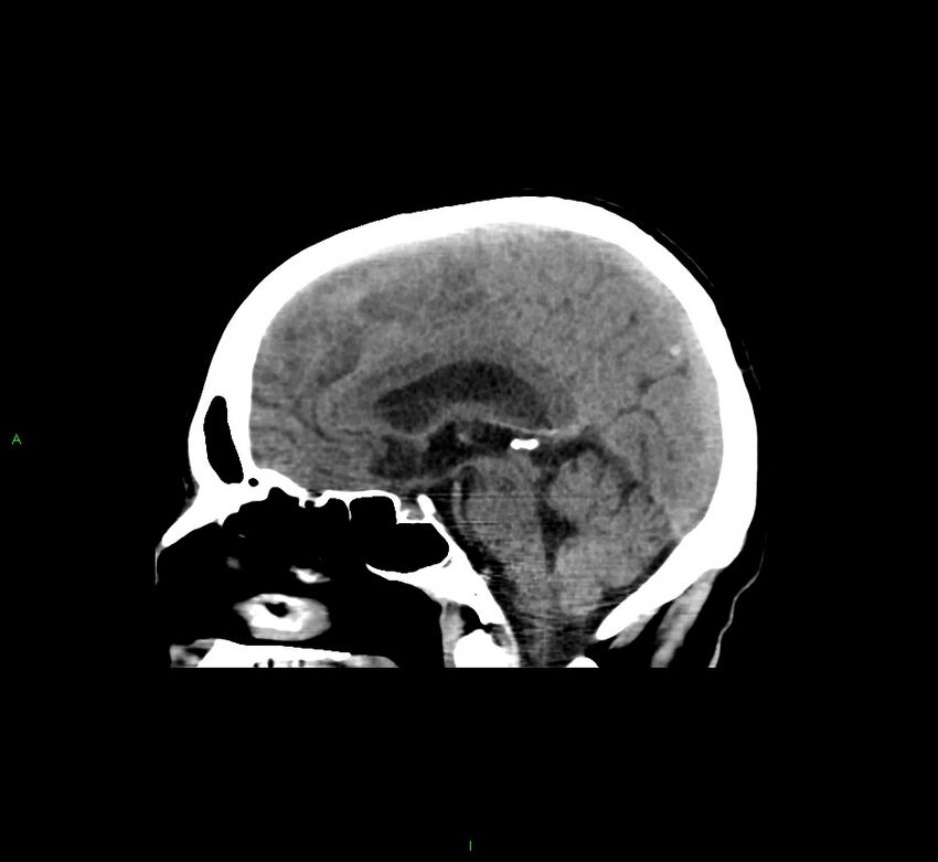 Cerebral amyloid angiopathy-associated lobar intracerebral hemorrhage (Radiopaedia 58529-65681 B 24).jpg
