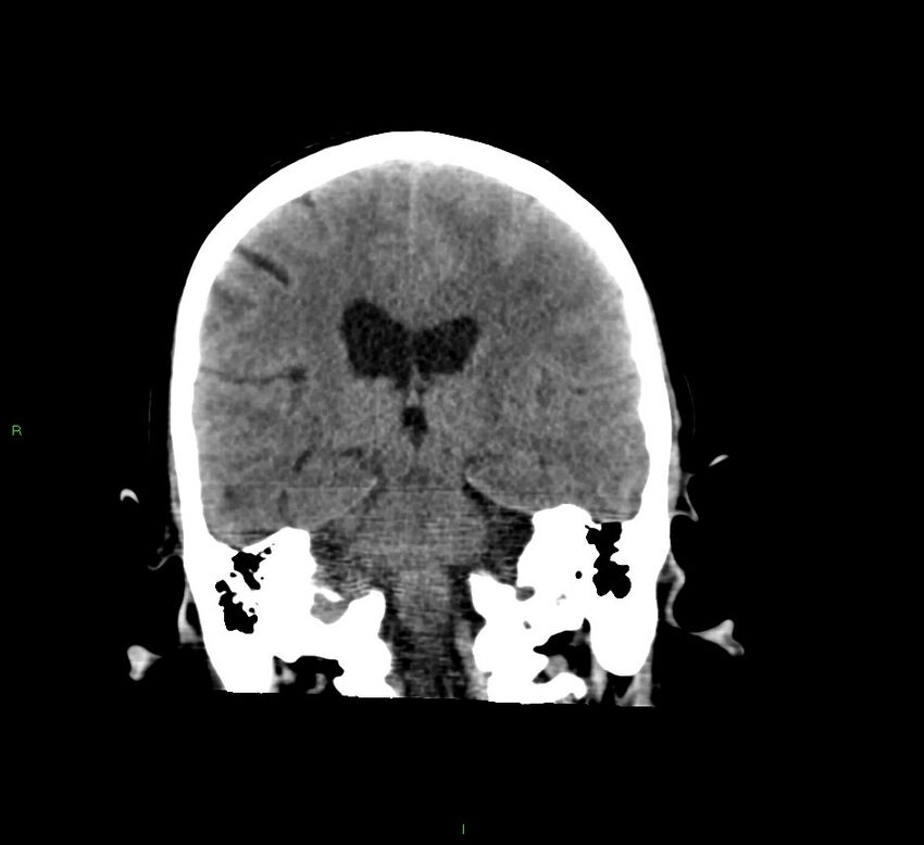 Cerebral amyloid angiopathy-associated lobar intracerebral hemorrhage (Radiopaedia 58529-65681 Coronal non-contrast 30).jpg