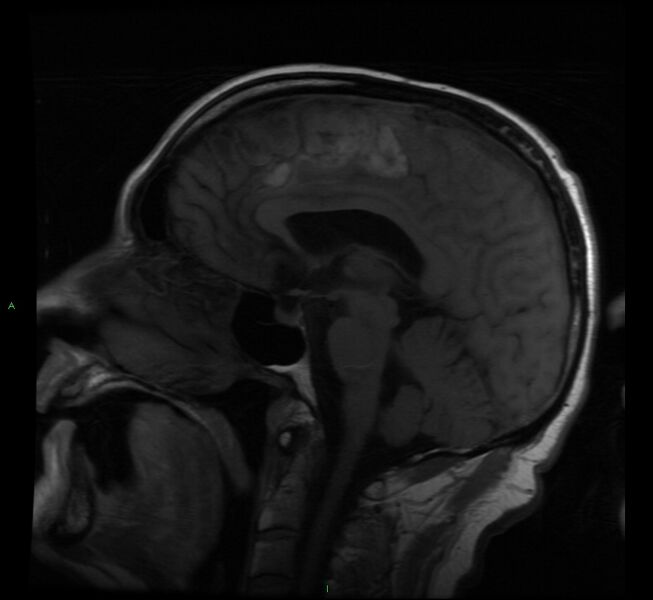 File:Cerebral amyloid angiopathy-associated lobar intracerebral hemorrhage (Radiopaedia 58529-65684 Sagittal T1 12).jpg