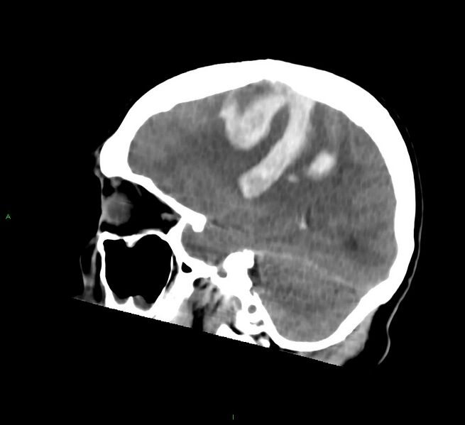 File:Cerebral amyloid angiopathy-associated lobar intracerebral hemorrhage (Radiopaedia 58756-65977 C 22).jpg