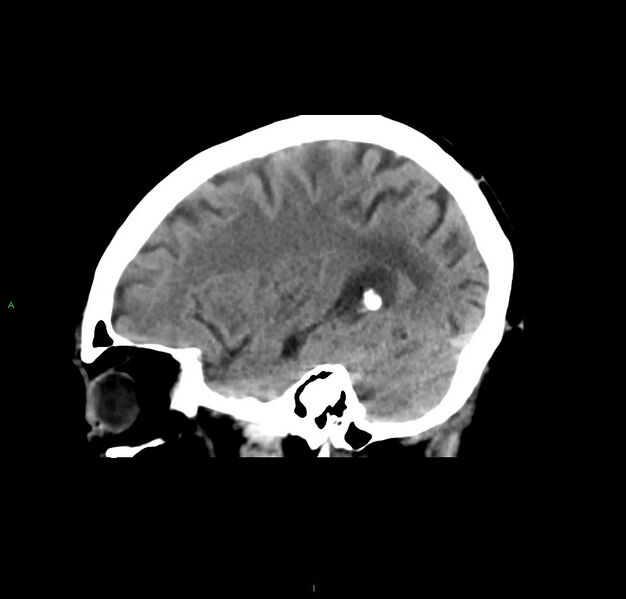 File:Cerebral amyloid angiopathy-associated lobar intracerebral hemorrhage (Radiopaedia 59356-66716 C 39).jpg