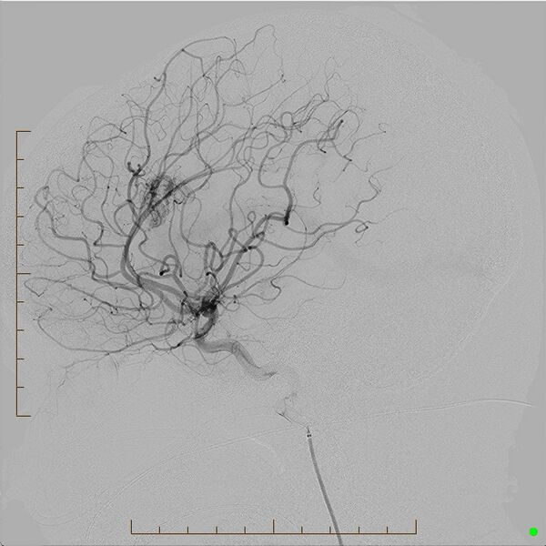 File:Cerebral arteriovenous malformation (AVM) (Radiopaedia 78162-90707 B 10).jpg