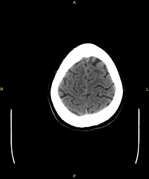 File:Cerebral autosomal dominant arteriopathy with subcortical infarcts and leukoencephalopathy (CADASIL) (Radiopaedia 86108-102051 Axial non-contrast 99).jpg