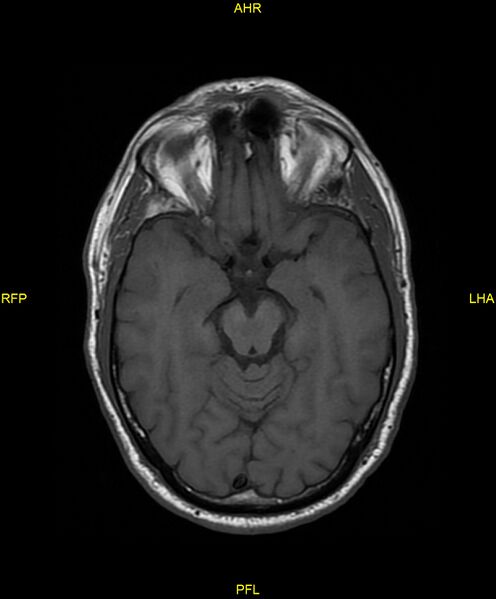 File:Cerebral autosomal dominant arteriopathy with subcortical infarcts and leukoencephalopathy (CADASIL) (Radiopaedia 86108-102054 Axial T1 12).jpg