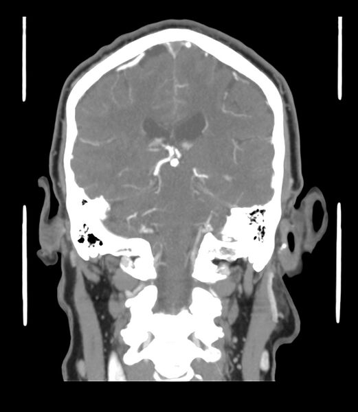 File:Cerebral dural venous sinus thrombosis (Radiopaedia 86514-102576 B 44).jpg