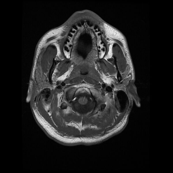 File:Cerebral fat embolism (Radiopaedia 37510-39363 Axial T1 3).jpg