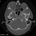 Cerebral hemorrhagic contusion with subdural and subarachnoid hemorrhage (Radiopaedia 10680-11146 Axial bone window 8).jpg