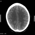 Cerebral hemorrhagic contusion with subdural and subarachnoid hemorrhage (Radiopaedia 10680-19197 Axial non-contrast 16).jpg