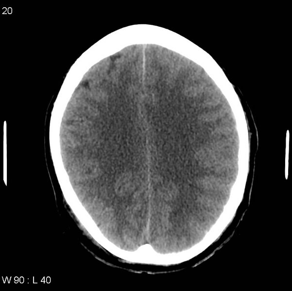 File:Cerebral hemorrhagic contusion with subdural and subarachnoid hemorrhage (Radiopaedia 10680-19197 Axial non-contrast 16).jpg