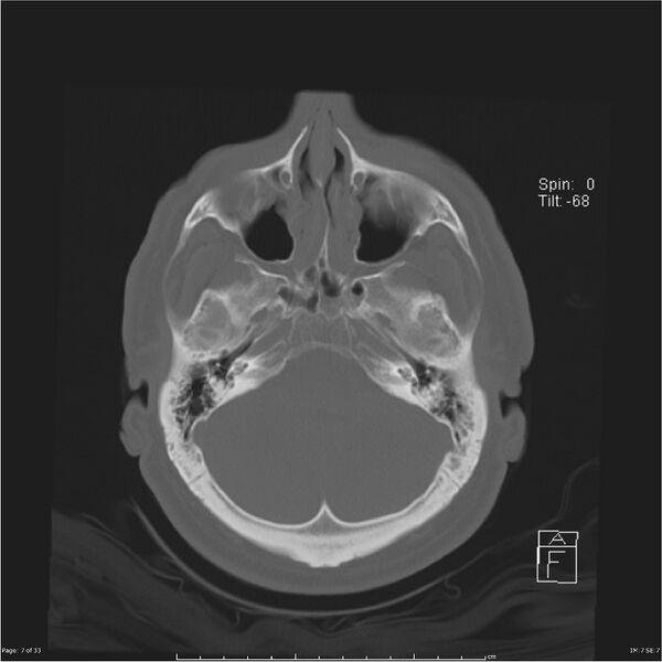 File:Cerebral hemorrhagic contusions and cervical spine fractures (Radiopaedia 32865-33841 Axial bone window 7).jpg