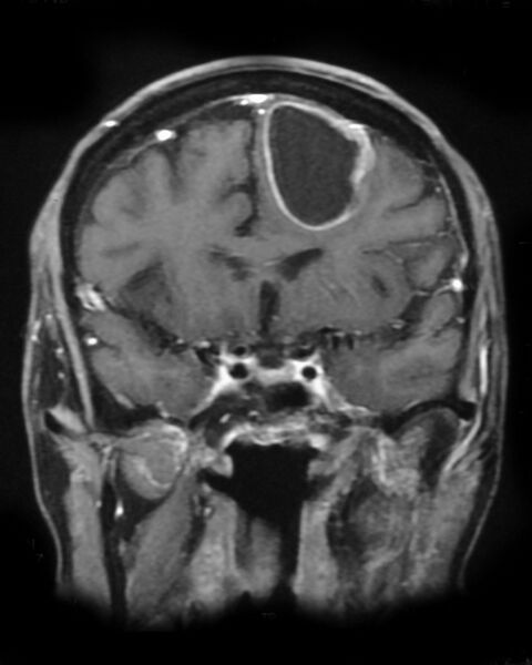 File:Cerebral metastases - small cell lung cancer (Radiopaedia 3972-6521 Coronal T1 C+ 1).jpg