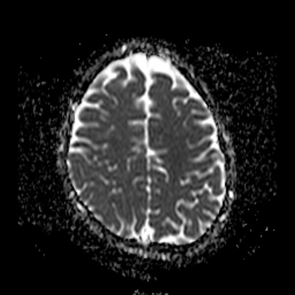 File:Cerebral tuberculoma (Radiopaedia 41152-43932 Axial ADC 18).jpg