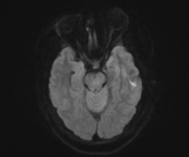 File:Cerebral venous infarct (Radiopaedia 53627-59685 Axial DWI 5).jpg