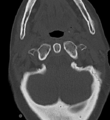 Cervical spine ACDF loosening (Radiopaedia 48998-54070 Axial bone window 14).png