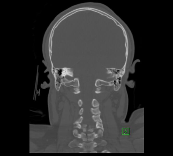 File:Cervical spine fracture - hyperflexion injury (Radiopaedia 66184-75364 Coronal bone window 9).jpg