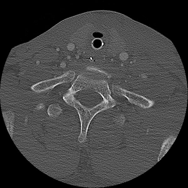 File:Cervical spine fractures with vertebral artery dissection (Radiopaedia 32135-33078 Axial bone window 3).jpg