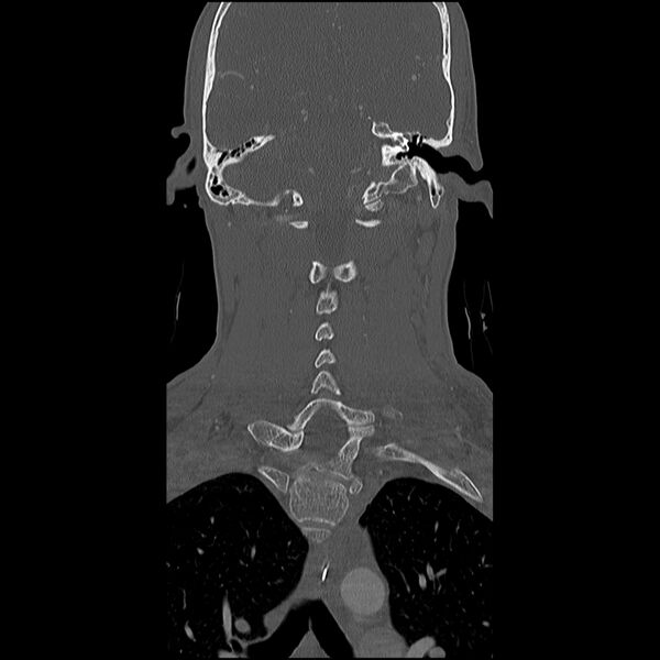 File:Cervical spine fractures with vertebral artery dissection (Radiopaedia 32135-33078 Coronal bone window 20).jpg