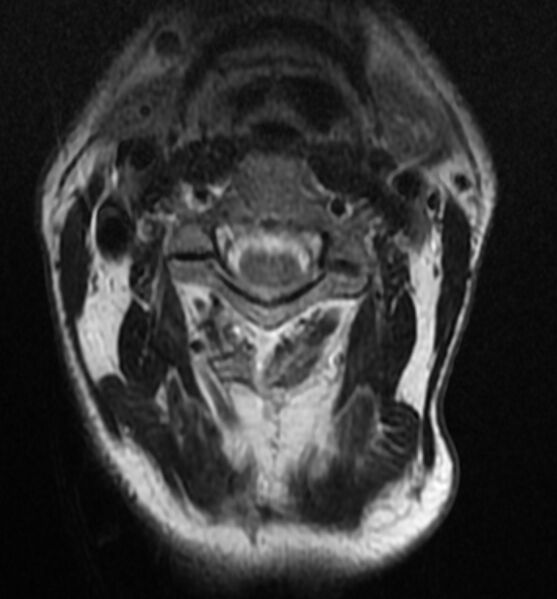 File:Cervical spondylodiscitis (Radiopaedia 81362-95110 Axial T2 3).jpg