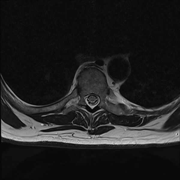 File:Cervical tumor-like myelopathy due to Type V dAVF (Radiopaedia 82461-96604 D 29).jpg