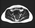 Cesarean section scar endometrioma (Radiopaedia 56569-63297 Axial T1 7).jpg