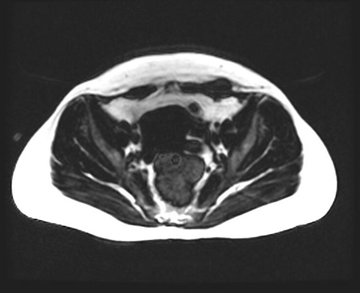 File:Cesarean section scar endometrioma (Radiopaedia 56569-63297 Axial T1 7).jpg