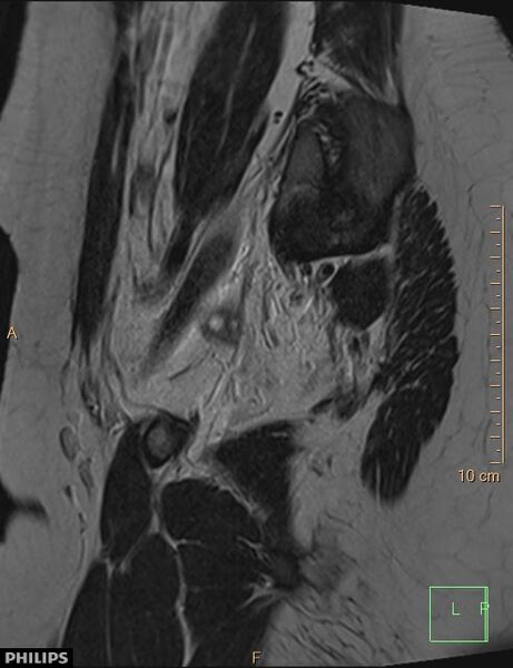 File:Cesarian scar endometriosis (Radiopaedia 68495-78066 Sagittal T2 4).jpg