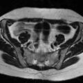 Cesarian section scar endometriosis (Radiopaedia 66520-75799 Axial T2 3).jpg