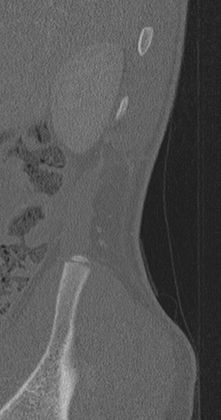 File:Chance fracture (Radiopaedia 40360-42912 Sagittal bone window 99).png