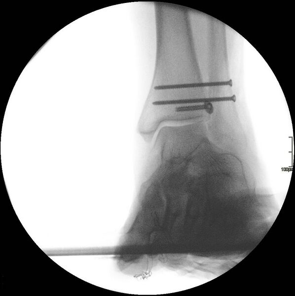 File:Chaput tubercle fracture (Radiopaedia 80319-93957 Frontal 1).jpg
