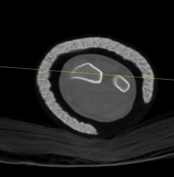 File:Chauffeur's (Hutchinson) fracture (Radiopaedia 58043-65079 Axial 16).png
