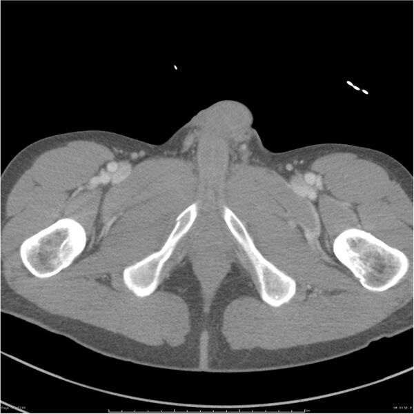 File:Chest and abdomen multi-trauma (Radiopaedia 26294-26426 bone window 94).jpg