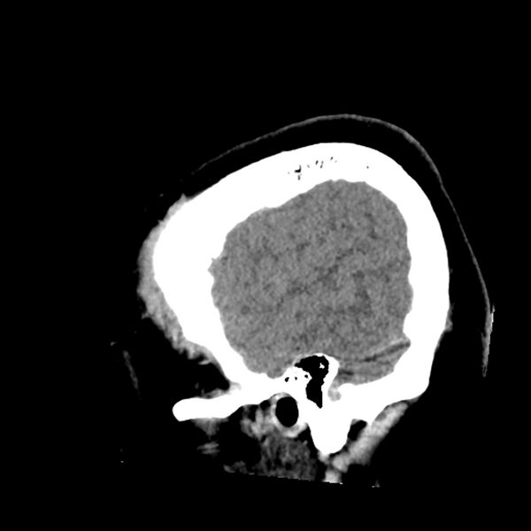 File:Chiasmatic-hypothalamic juvenile pilocytic astrocytoma (Radiopaedia 78533-91237 B 13).jpg