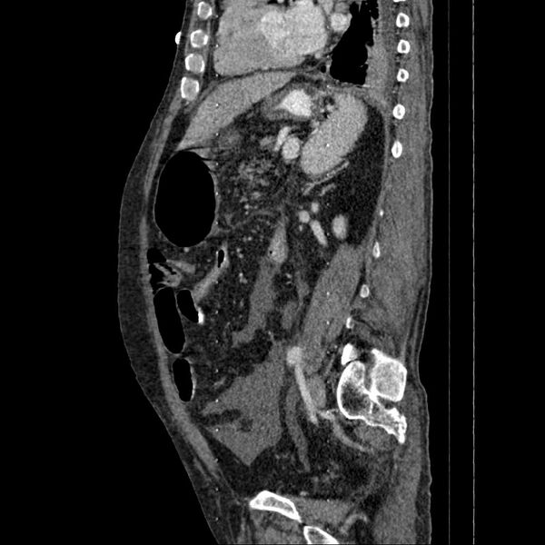 File:Cholangitis and abscess formation in a patient with cholangiocarcinoma (Radiopaedia 21194-21100 B 7).jpg