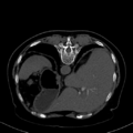 Cholecystitis - CT IVC obstructive choledocholitiasis (Radiopaedia 43966-47479 Axial Biliscopin 28).png