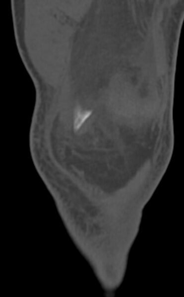 File:Chondrocalcinosis (Radiopaedia 82862-97173 Coronal bone window 19).jpg