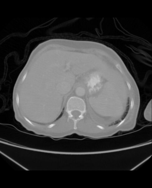 File:Chondrosarcoma (Radiopaedia 79427-92535 Axial lung window 50).jpg