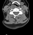 Chordoma (C4 vertebra) (Radiopaedia 47561-52188 Axial non-contrast 28).png