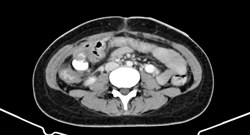 File:Choriocarcinoma liver metastases (Radiopaedia 74768-85766 A 122).jpg