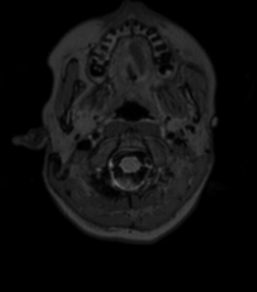 File:Choroid plexus carcinoma (Radiopaedia 91013-108553 Axial T2 fat sat 24).jpg