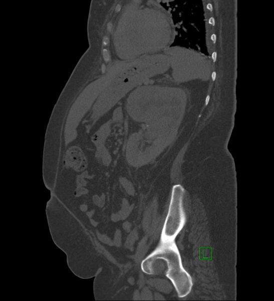 File:Chromophobe renal cell carcinoma (Radiopaedia 84239-99519 Sagittal bone window 34).jpg