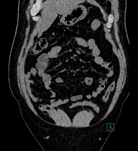 File:Chromophobe renal cell carcinoma (Radiopaedia 84286-99573 Coronal non-contrast 39).jpg