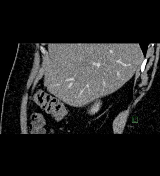 File:Chromophobe renal cell carcinoma (Radiopaedia 84286-99573 F 141).jpg