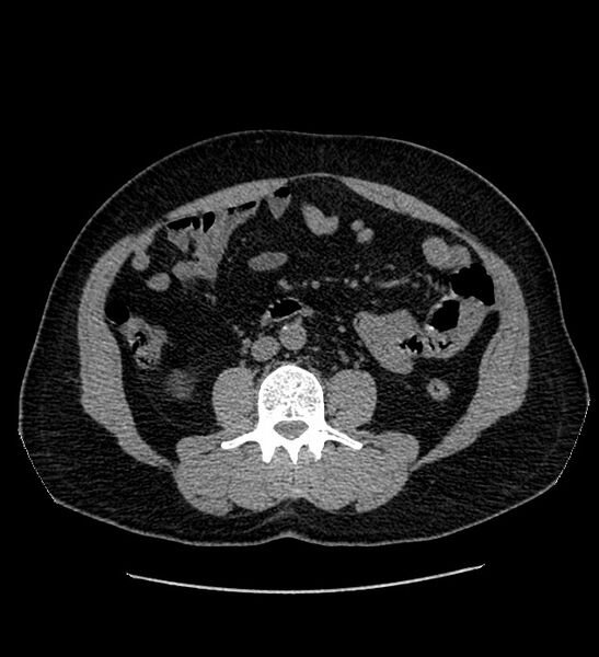 File:Chromophobe renal cell carcinoma (Radiopaedia 84337-99693 Axial non-contrast 77).jpg