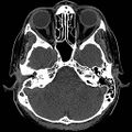 Chronic otomastoiditis (Radiopaedia 27138-27309 Axial non-contrast 1).jpg
