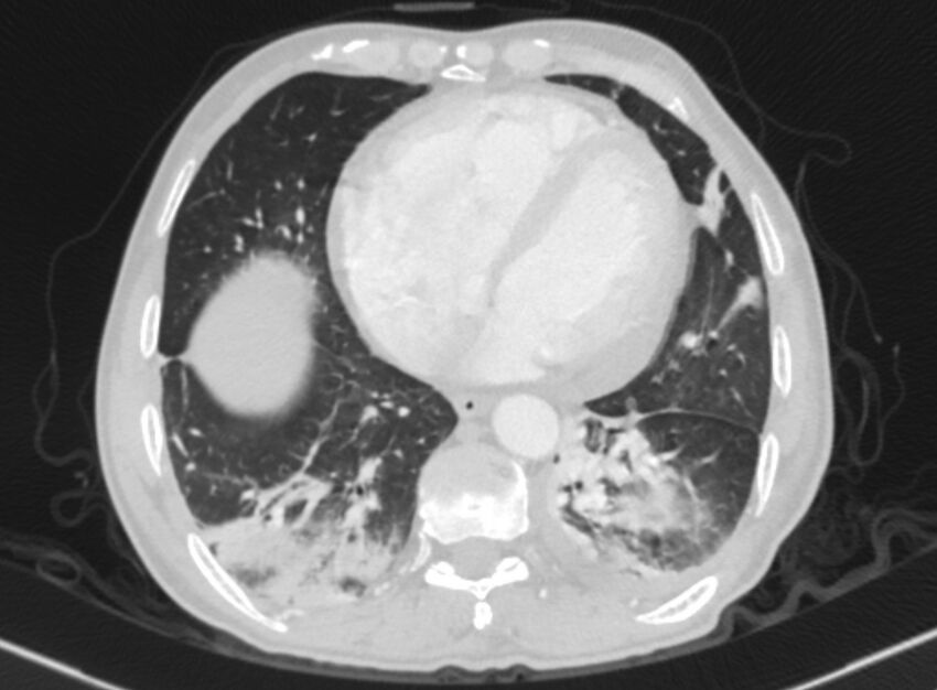 Chronic pulmonary embolism with bubbly consolidation (Radiopaedia 91248-108850 Axial lung window 114).jpg