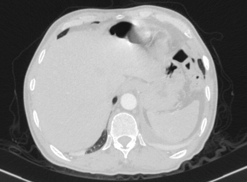 File:Chronic pulmonary embolism with bubbly consolidation (Radiopaedia 91248-108850 Axial lung window 137).jpg