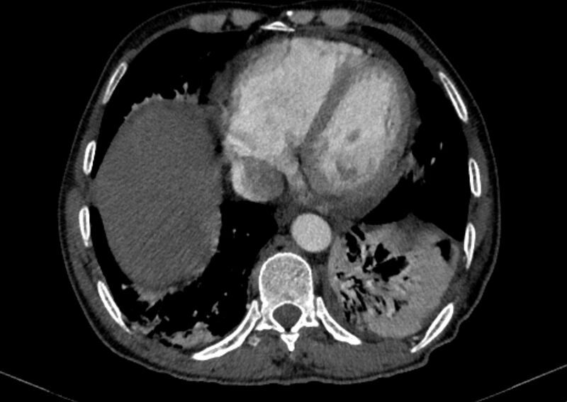 File:Chronic pulmonary embolism with bubbly consolidation (Radiopaedia 91248-108850 C+ arterial phase 116).jpg