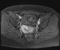 Class II Mullerian duct anomaly- unicornuate uterus with rudimentary horn and non-communicating cavity (Radiopaedia 39441-41755 Axial T1 fat sat 67).jpg