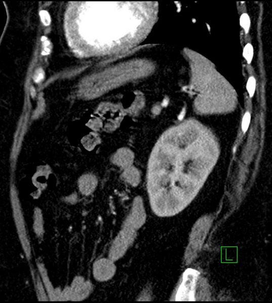 File:Clear cell renal cell carcinoma (Radiopaedia 85004-100537 D 18).jpg
